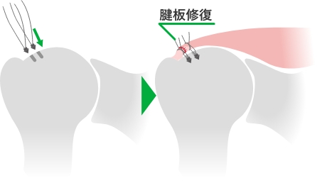 腱修復手術後に痛みが生じた場合の対処法
