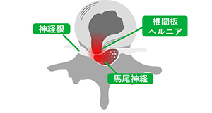 図1 椎間板ヘルニアによる神経根の圧迫