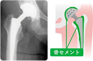 骨セメント型 人工股関節